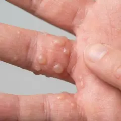 Nahaufnahme einer Hand mit Bläschen, die auf ein dyshidrotisches Ekzem hindeuten.