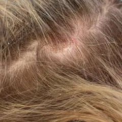 Nahaufnahme einer Kopfhaut mit sichtbaren Schuppen und Rötungen. Die Haare sind hellbraun und durchzogen von feinen Schuppen.