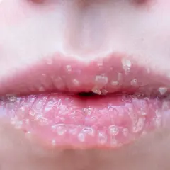 Nahaufnahme von zarten, rosafarbenen Lippen mit Zuckerkristallen, die auf empfindliche Lippen hinweisen, die eine Pflege benötigen.