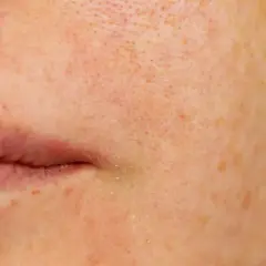 Nahaufnahme der Haut mit sichtbaren, erweiterten Poren und Sommersprossen neben den Lippen.