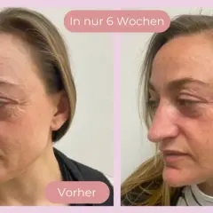 Vorher-nachher Vergleich der Haut nach 6 Wochen Anwendung von Vitamin C. Deutliche Reduzierung von Falten und Verbesserung des Hautbildes.