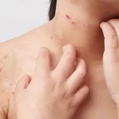 Haut mit roten Flecken und Kratzern, die auf Neurodermitis Pusteln hindeuten. Eine Hand kratzt sich am Hals.