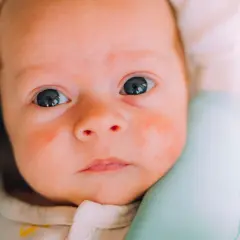 Nahaufnahme eines Babys mit roten Flecken im Gesicht, die auf Hitzepickel hindeuten.