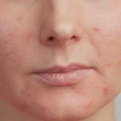 Nahaufnahme eines Gesichts mit Rötungen und Pickelmalen. Tipps, um Pickelmale loswerden, sind hier relevant.