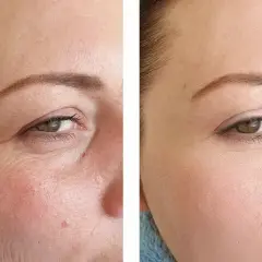 Vorher-Nachher-Vergleich: Faltenreduktion durch Vitamin C oder Retinol. Die Haut wirkt glatter und jugendlicher.