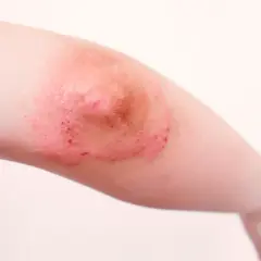 Rote, schuppige Haut mit kleinen Blutungen am Ellenbogen, die wie Pickel aussehen.