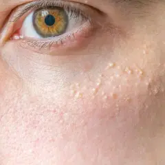 Nahaufnahme des Gesichts mit kleinen weißen Pickelchen, die sich auf der Haut am Kinn und unter dem Auge befinden.