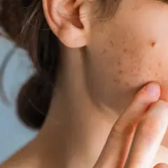 Nahaufnahme eines Gesichts, das zeigt, wie sehen stresspickel aus: kleine rote und braune Flecken auf der Haut, die eine Person mit dem Finger berührt.