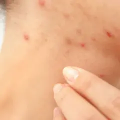 Haut mit Rötungen und Pickelchen, die auf Stress und damit verbundene Cortisol-Akne hindeuten. Eine Hand berührt sanft die betroffene Stelle.