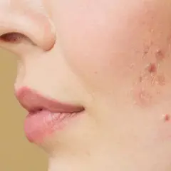 Nahaufnahme einer Wange mit Akne vulgaris, die Rötungen und Pickel zeigt.