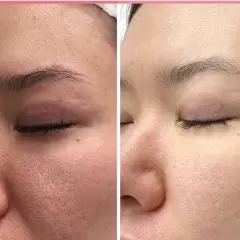 Vergleich: Hautbild vor und nach der Anwendung von Retinol. Deutlich sichtbare Poren werden feiner und die Haut wirkt glatter.