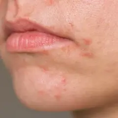 Nahaufnahme von geröteter Haut um den Mund, die auf periorale Dermatitis hinweist. Sanfte Hautpflege ist hier wichtig.