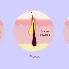Illustration zeigt, was tun bei Furunkel: Normal, Pickel und Furunkel mit Eiterbildung im Haarfollikel.