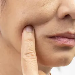 Nahaufnahme einer Frau, die mit dem Finger auf ihre Wange tippt. Die Haut zeigt Falten und Pigmentflecken, Anzeichen von **Hautalterung durch Sonne**.