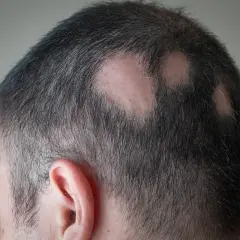 Mann mit kreisrundem Haarausfall am Hinterkopf. Vielleicht helfen Hausmittel gegen Kopfhautjucken.