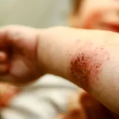 Babyarm mit geröteter, wund gekratzter Stelle, die stark juckt. Neurodermitis-Schub.