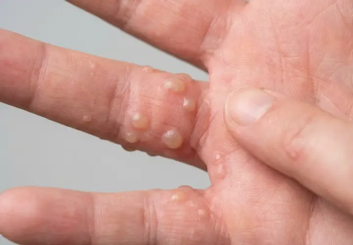 Nahaufnahme einer Hand mit Bläschen, die auf ein dyshidrotisches Ekzem hindeuten.