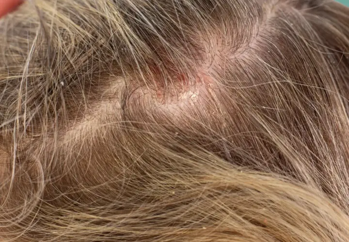 Nahaufnahme einer Kopfhaut mit sichtbaren Schuppen und Rötungen. Die Haare sind hellbraun und durchzogen von feinen Schuppen.