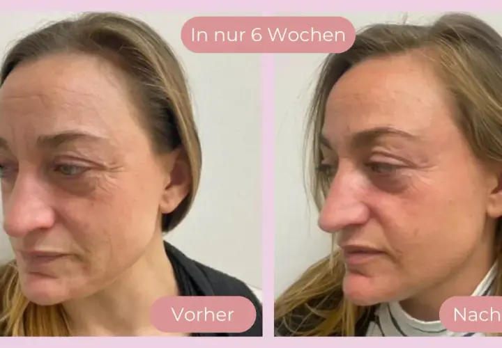 Vorher-nachher Vergleich der Haut nach 6 Wochen Anwendung von Vitamin C. Deutliche Reduzierung von Falten und Verbesserung des Hautbildes.