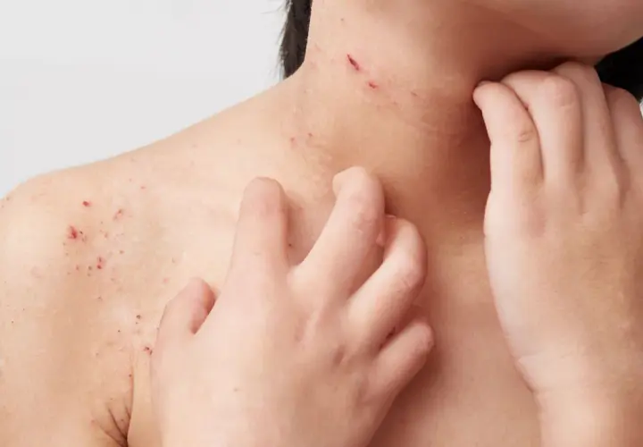Haut mit roten Flecken und Kratzern, die auf Neurodermitis Pusteln hindeuten. Eine Hand kratzt sich am Hals.