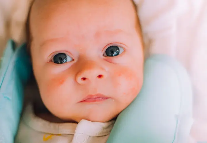 Nahaufnahme eines Babys mit roten Flecken im Gesicht, die auf Hitzepickel hindeuten.