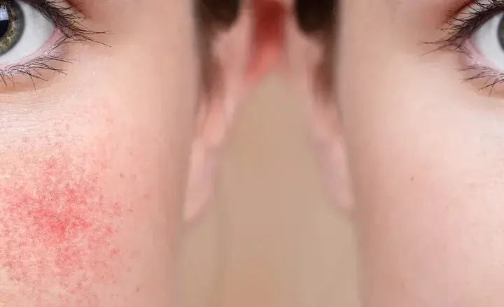 Vorher-Nachher-Vergleich: Rötungen bei Rosacea werden durch Hyaluron deutlich gemildert.