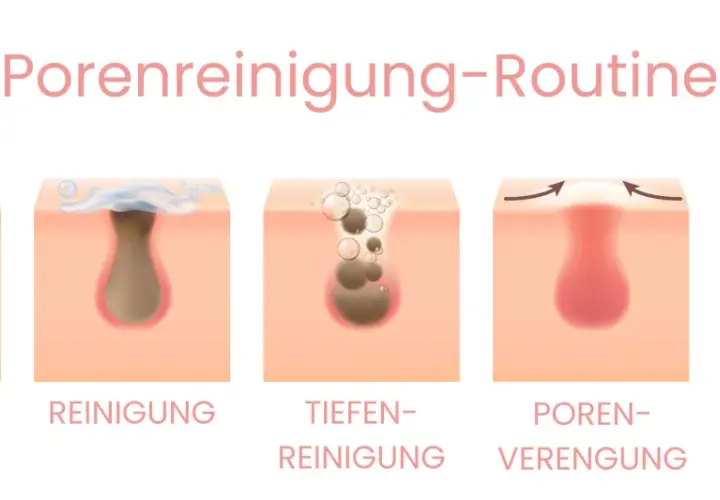 Schritt-für-Schritt-Anleitung zur Porenreinigung: Vorher sind geschlossene Mitesser sichtbar, dann Reinigung, Tiefenreinigung, Porenverengung und schließlich das Ergebnis.