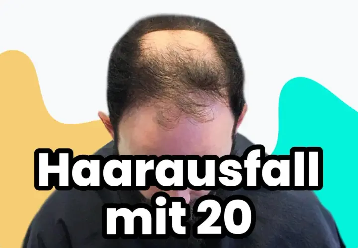 Mann mit Haarausfall mit 20 Jahren, der sich Sorgen macht.