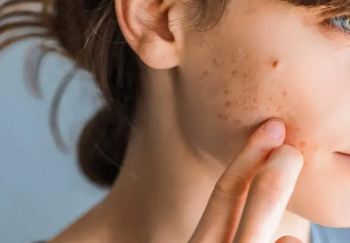 Nahaufnahme eines Gesichts, das zeigt, wie sehen stresspickel aus: kleine rote und braune Flecken auf der Haut, die eine Person mit dem Finger berührt.