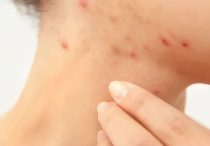 Haut mit Rötungen und Pickelchen, die auf Stress und damit verbundene Cortisol-Akne hindeuten. Eine Hand berührt sanft die betroffene Stelle.