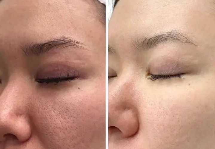 Vergleich: Hautbild vor und nach der Anwendung von Retinol. Deutlich sichtbare Poren werden feiner und die Haut wirkt glatter.
