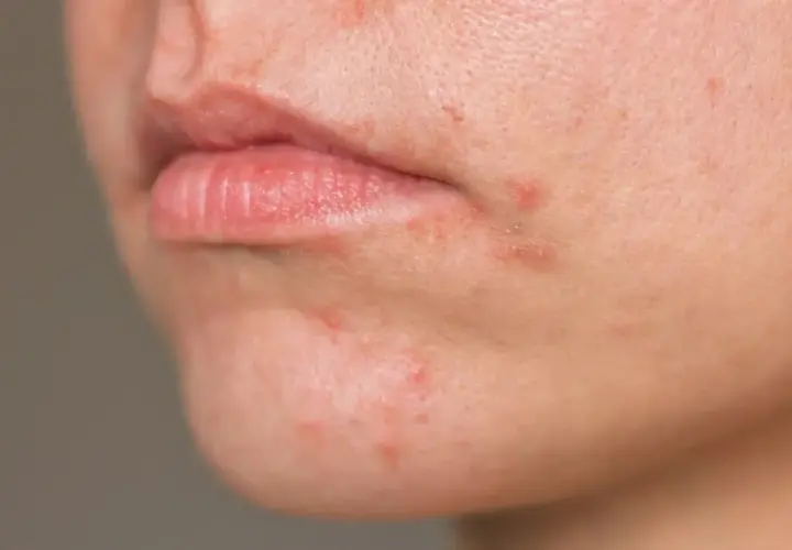 Nahaufnahme von geröteter Haut um den Mund, die auf periorale Dermatitis hinweist. Sanfte Hautpflege ist hier wichtig.