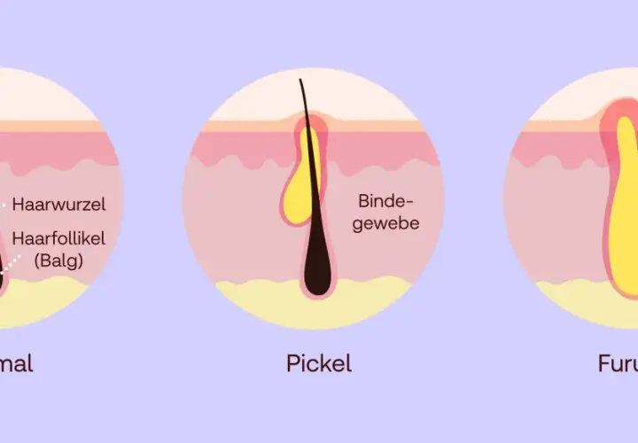 Illustration zeigt, was tun bei Furunkel: Normal, Pickel und Furunkel mit Eiterbildung im Haarfollikel.