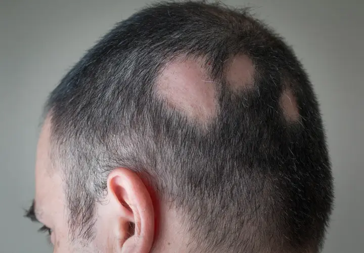 Mann mit kreisrundem Haarausfall am Hinterkopf. Vielleicht helfen Hausmittel gegen Kopfhautjucken.