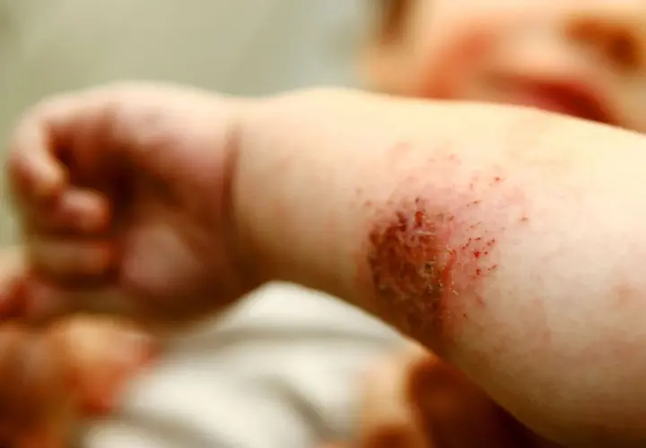 Babyarm mit geröteter, wund gekratzter Stelle, die stark juckt. Neurodermitis-Schub.