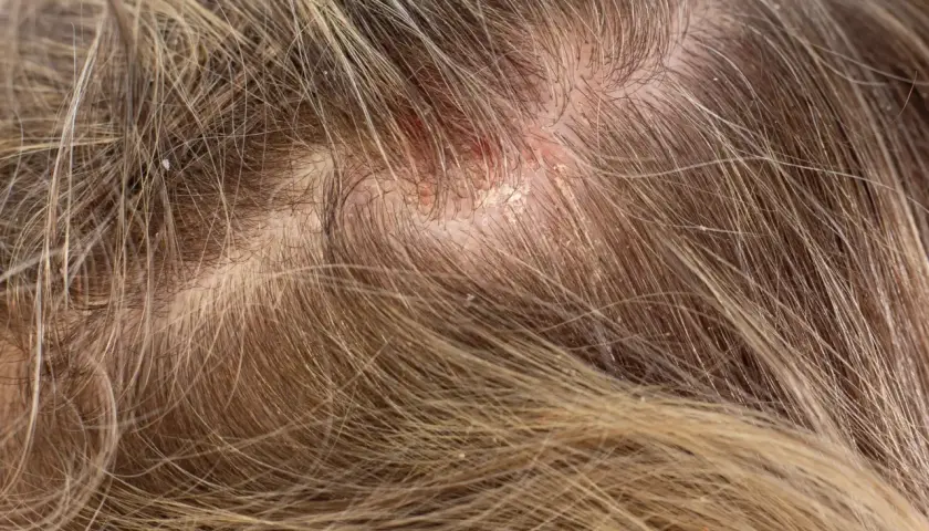 Nahaufnahme einer Kopfhaut mit sichtbaren Schuppen und Rötungen. Die Haare sind hellbraun und durchzogen von feinen Schuppen.