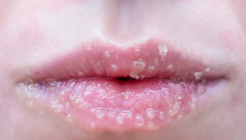 Nahaufnahme von zarten, rosafarbenen Lippen mit Zuckerkristallen, die auf empfindliche Lippen hinweisen, die eine Pflege benötigen.