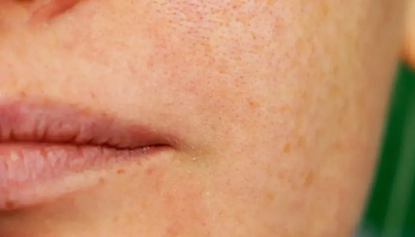 Nahaufnahme der Haut mit sichtbaren, erweiterten Poren und Sommersprossen neben den Lippen.