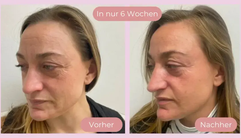 Vorher-nachher Vergleich der Haut nach 6 Wochen Anwendung von Vitamin C. Deutliche Reduzierung von Falten und Verbesserung des Hautbildes.