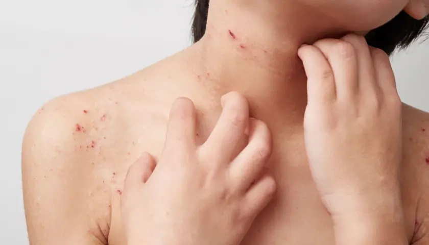 Haut mit roten Flecken und Kratzern, die auf Neurodermitis Pusteln hindeuten. Eine Hand kratzt sich am Hals.