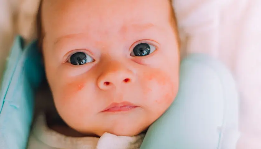 Nahaufnahme eines Babys mit roten Flecken im Gesicht, die auf Hitzepickel hindeuten.