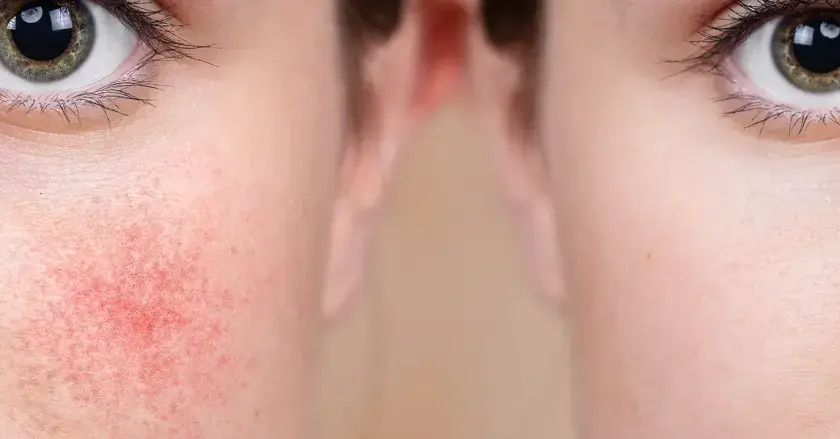 Vorher-Nachher-Vergleich: Rötungen bei Rosacea werden durch Hyaluron deutlich gemildert.