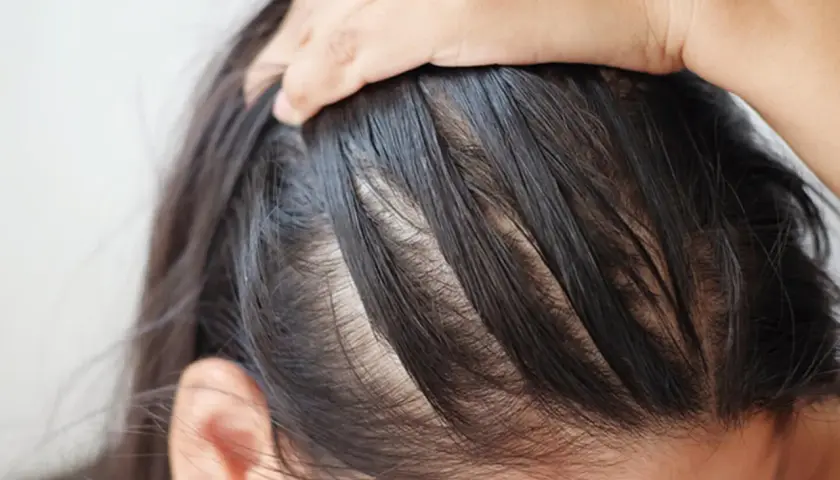 Nahaufnahme der Kopfhaut einer Person, die sich durch dünner werdendes Haar und sichtbare Ansätze auszeichnet, was auf mögliche Probleme wie Neurodermitis Kopfhaut hindeuten könnte.