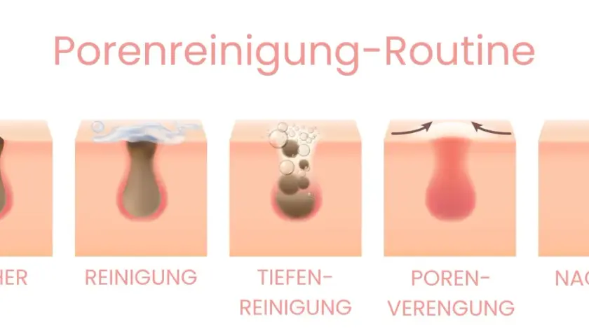 Schritt-für-Schritt-Anleitung zur Porenreinigung: Vorher sind geschlossene Mitesser sichtbar, dann Reinigung, Tiefenreinigung, Porenverengung und schließlich das Ergebnis.