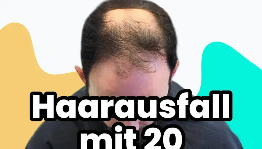 Mann mit Haarausfall mit 20 Jahren, der sich Sorgen macht.