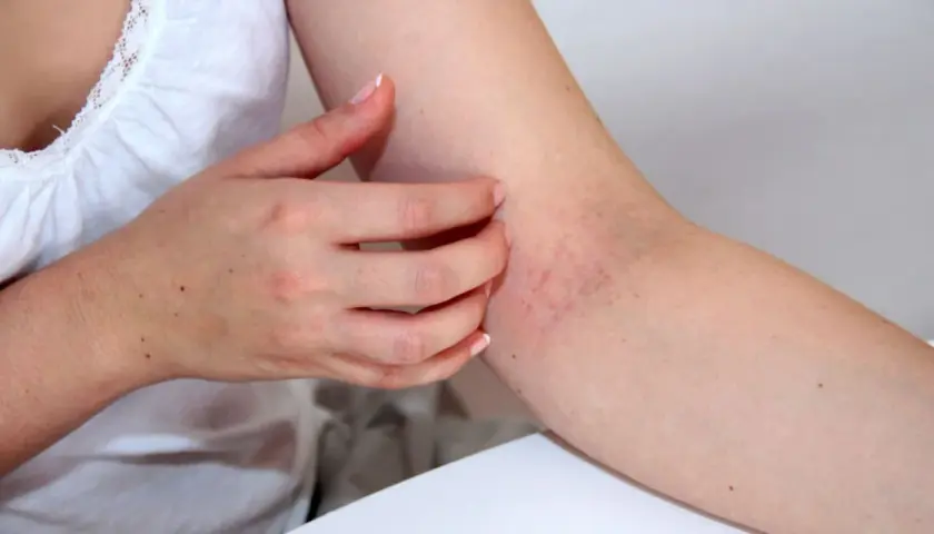 Juckende Haut am Arm, Anzeichen von Neurodermitis. Vielleicht hilft ein Cleopatra-Bad?