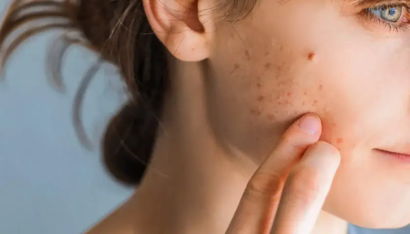Nahaufnahme eines Gesichts, das zeigt, wie sehen stresspickel aus: kleine rote und braune Flecken auf der Haut, die eine Person mit dem Finger berührt.