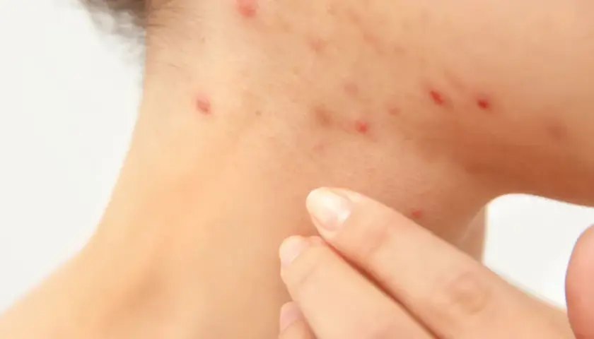 Haut mit Rötungen und Pickelchen, die auf Stress und damit verbundene Cortisol-Akne hindeuten. Eine Hand berührt sanft die betroffene Stelle.