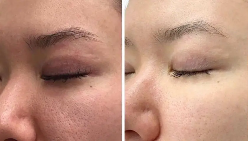 Vergleich: Hautbild vor und nach der Anwendung von Retinol. Deutlich sichtbare Poren werden feiner und die Haut wirkt glatter.