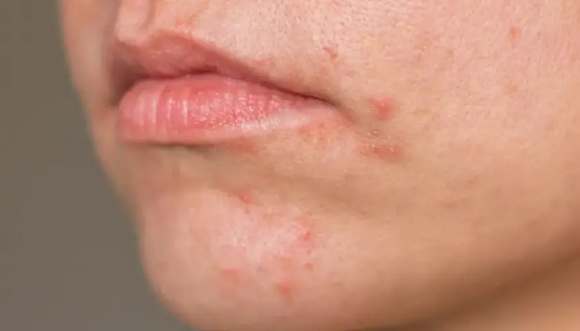 Nahaufnahme von geröteter Haut um den Mund, die auf periorale Dermatitis hinweist. Sanfte Hautpflege ist hier wichtig.